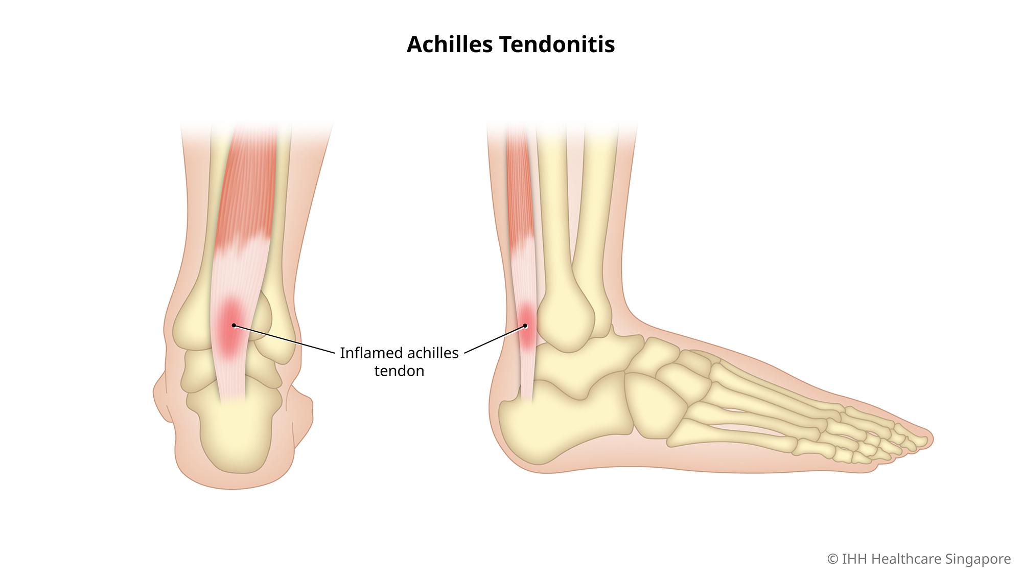 Achilles Tendonitis
